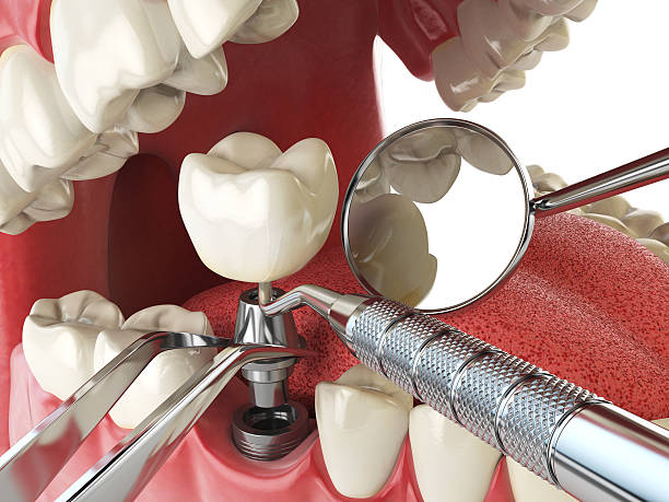Best Emergency Wisdom Teeth Removal in Lacon, IL