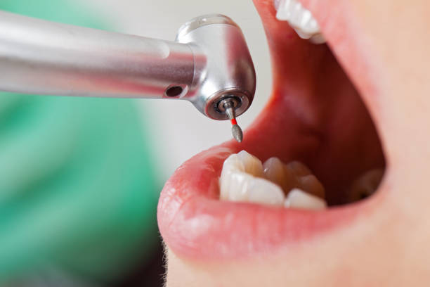 Best Emergency Tooth Extraction in Lacon, IL